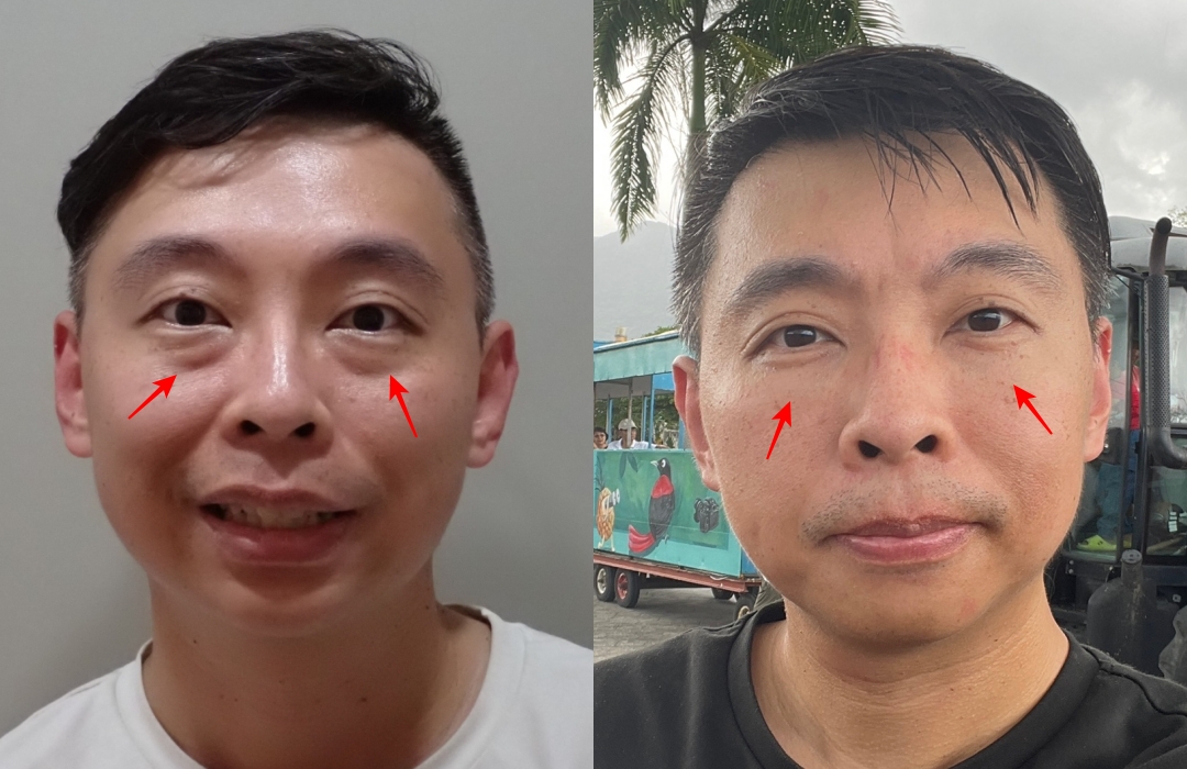 彥靚診所玻尿酸消除眼袋心得｜醫美小白初體驗！自然改善眼袋與疲憊感，不用手術也能改善眼袋？醫師技術、護理服務完整分享